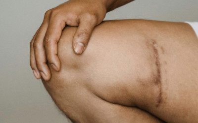 Healing Touch: Everything You Need to Know About Scar Massage